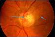 ﻿Proliferative diabetic retinopathy predictive and preventive